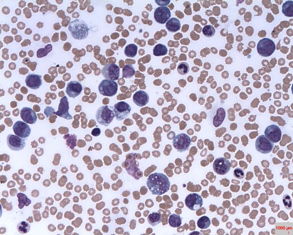 Leukaemia cells