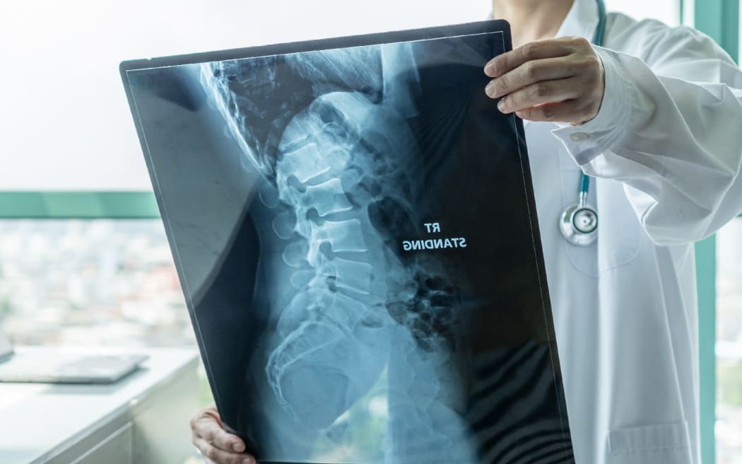 A doctor holds a spinal x-ray image.