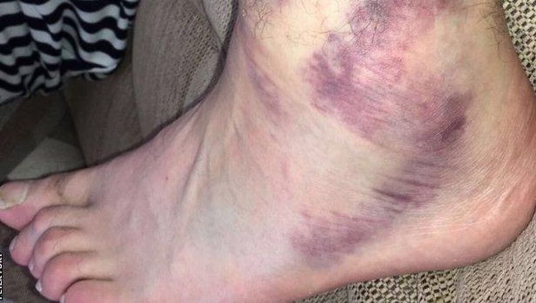 Tyson Fury sprains ankle.