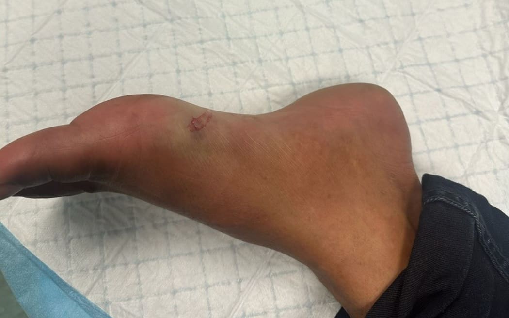 Stingray wound of Faisal Syafii