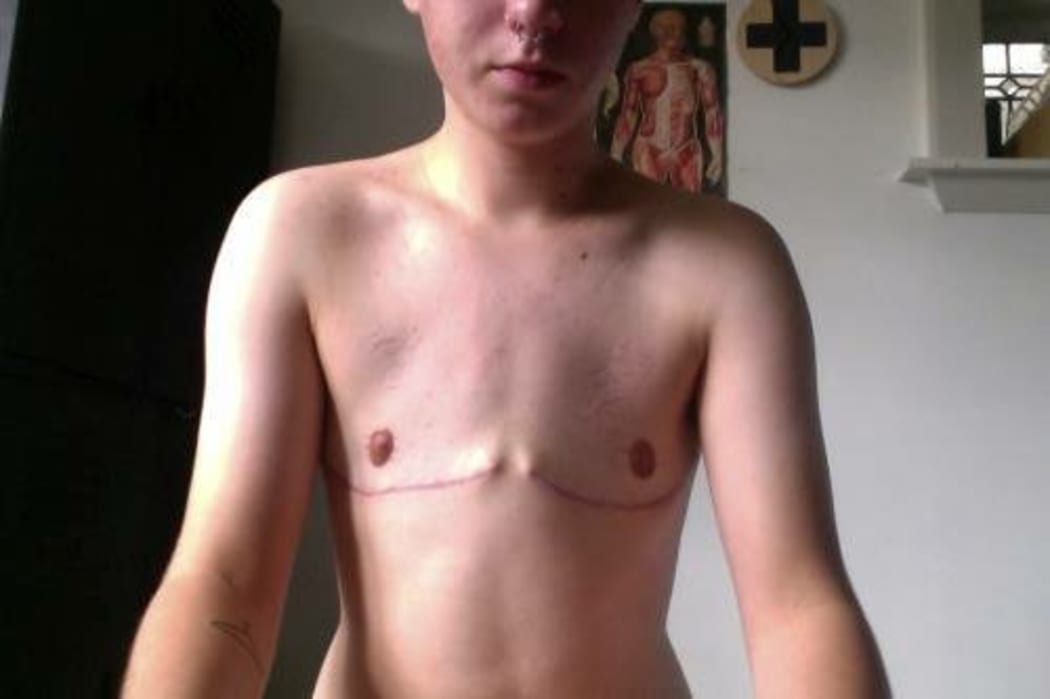 Oliver shortly after having his breasts removed.