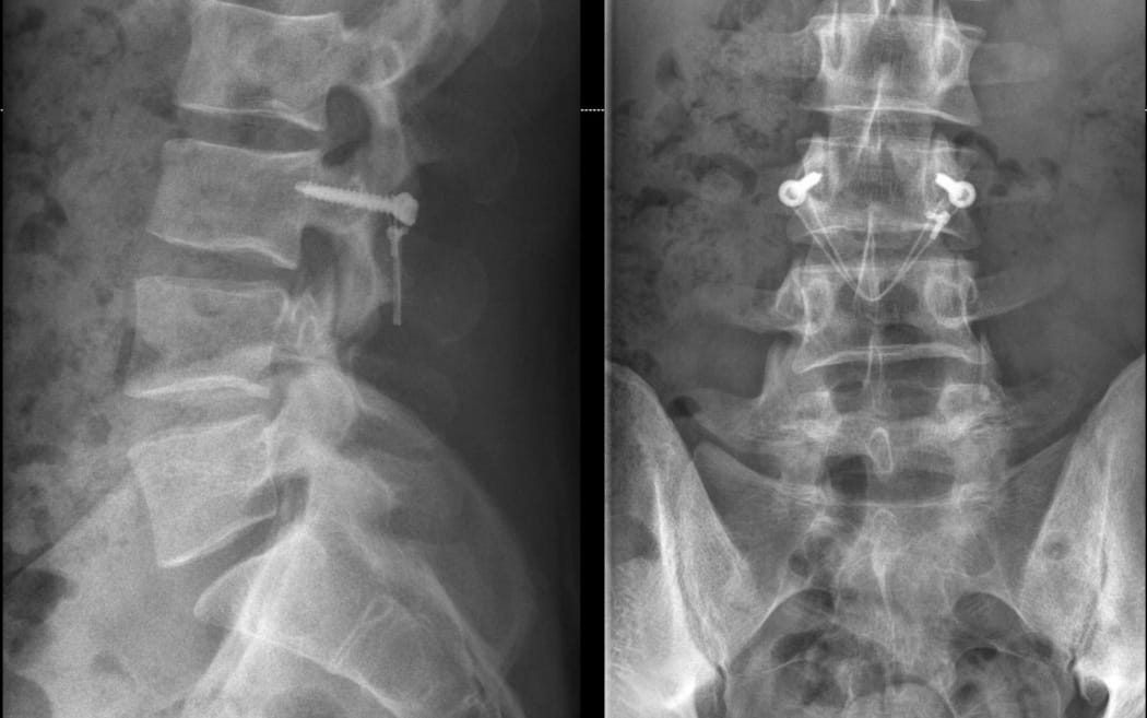 Orthopaedic spine surgeon Dr Rowan Schouten operates on a chronic back injury.