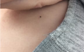 A person lifts up their shirt to show a small black dot on their skin; a tattoo left over from cancer radiation treatment.