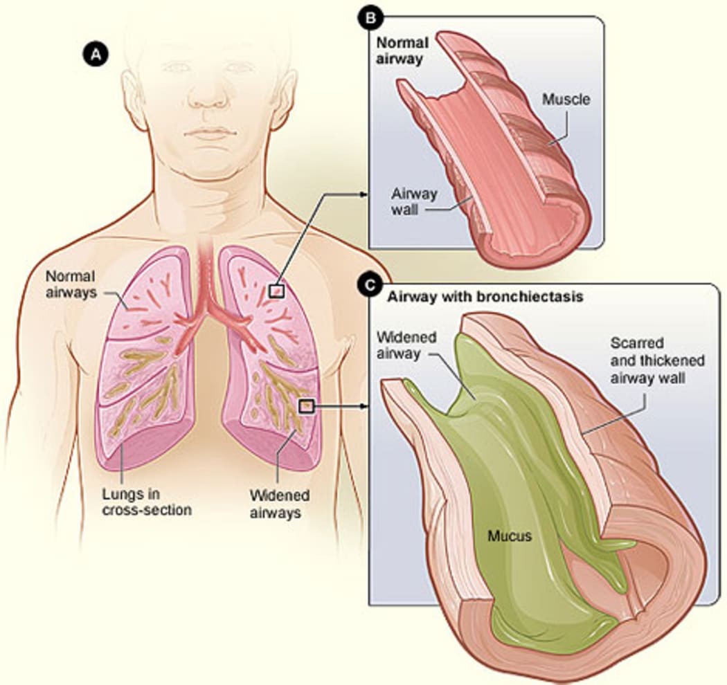 A diagram shows an airway with bronchiectasis.