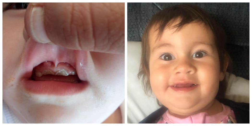 Ivy Dyas before (left) and after having surgery to remove her rotten teeth and abscess.