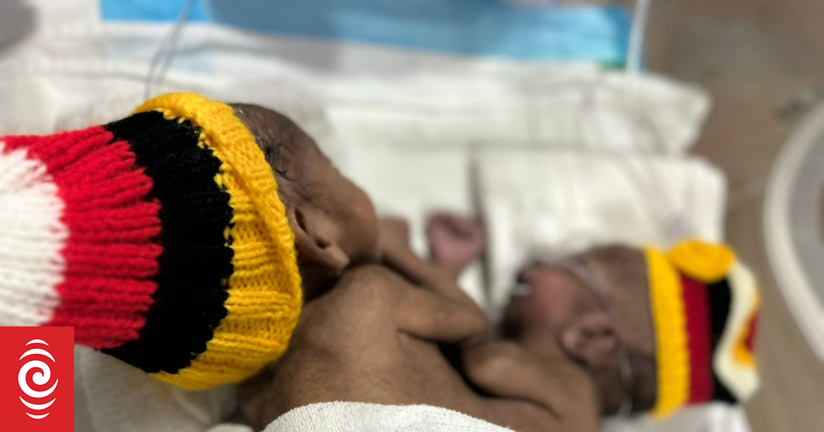 Rare PNG conjoined twins en route to Australia as case reaches 'critical' point