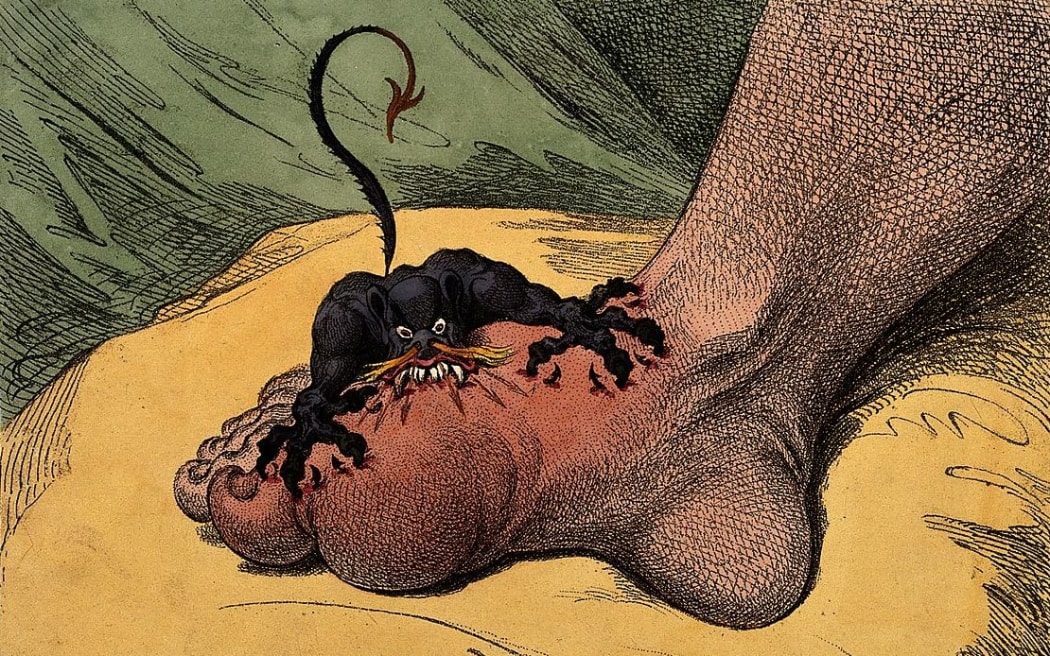 Gout is represented by an attacking demon in a 1799 etching by James Gillray.