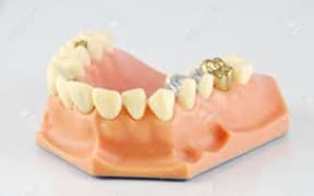 gold teeth