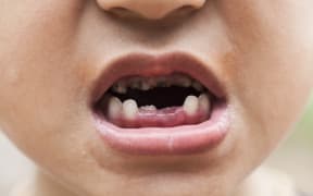 Tooth decay