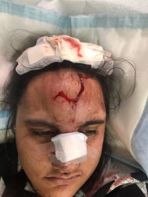 Rachel Nelson needed 15 stitches in her face after falling on concrete during a seizure. Her mother believes her condition has worsened after Pharmac switched patients to a generic drug.