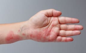 Shingles symptoms on arm