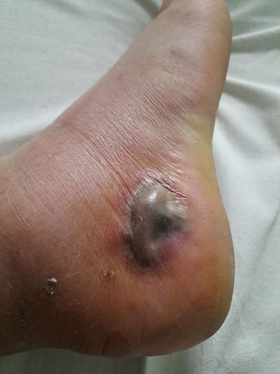 Kingsley Ridings' foot was injured and became infected after standing on a rusted piece of metal at a Rotorua boat ramp. Photo / Supplied