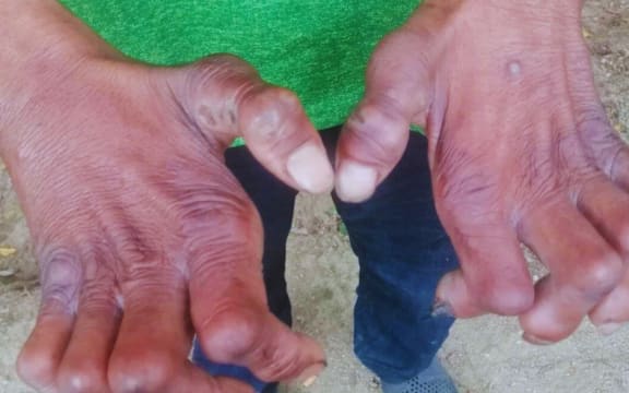According to Leprosy Mission NZ, there are thousands of undiagnosed leprosy cases.