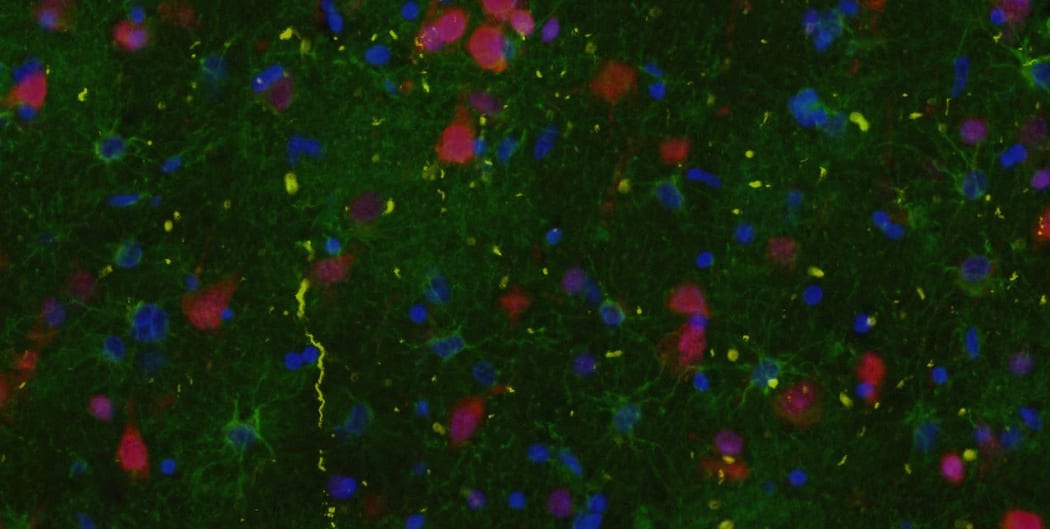 Parkinson's disease brain tissue with specific proteins & DNA tagged with fluorescent molecules.