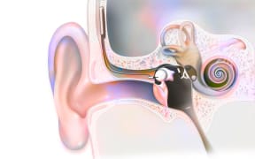 Cochlea implant 
Ear: hearing aid (Esteem) implantable in the inner ear. (Photo by JACOPIN / BSIP / BSIP via AFP)