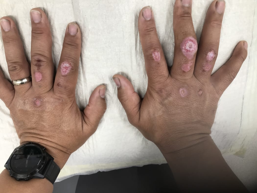 Burns sustained by a recruit at FENZ National Training Centre in February 2019