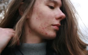 Acne rates in New Zealand are going down.
