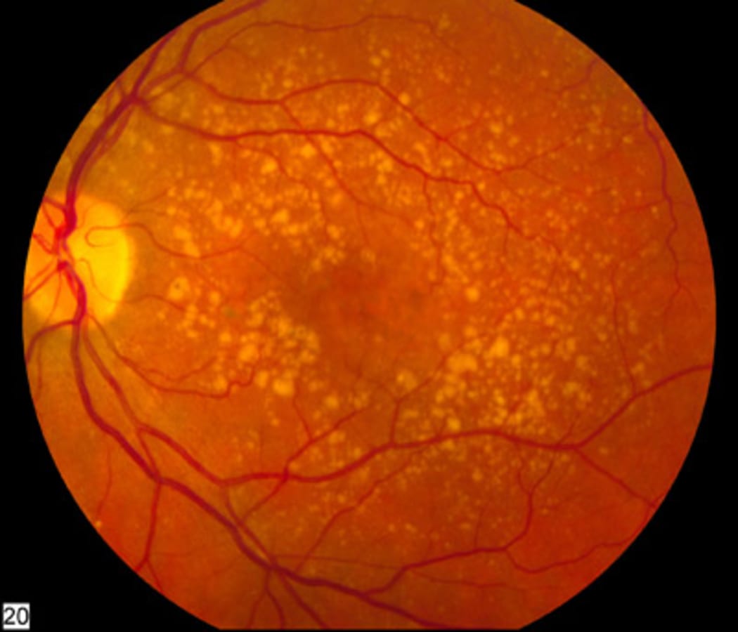 Intermediate_age_related_macular_degeneration