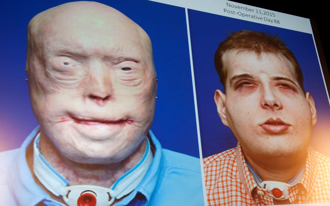 Patrick Hardison before and after his face transplant.