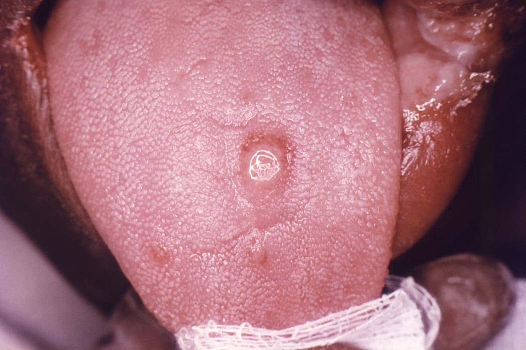 A chancre is often a first sign of syphilis.