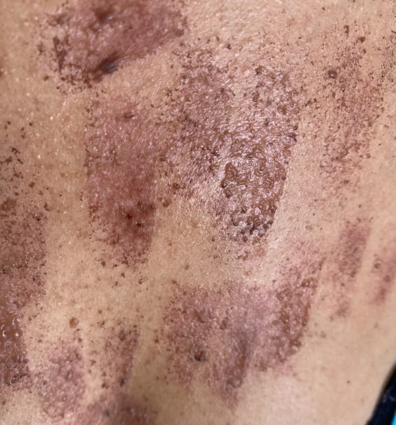 A Wellington woman has been left with burn marks all over her chest from an IPL treatment on 8 February 2024 (for use with this story ONLY).