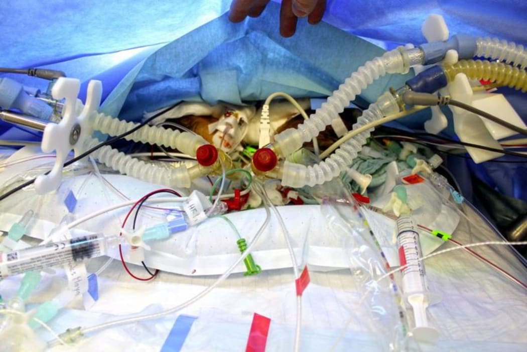 Conjoined twins Lydia and Maya were successfully separated at eight-days old.