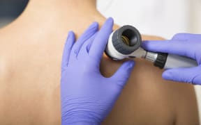 Mole dermoscopy.