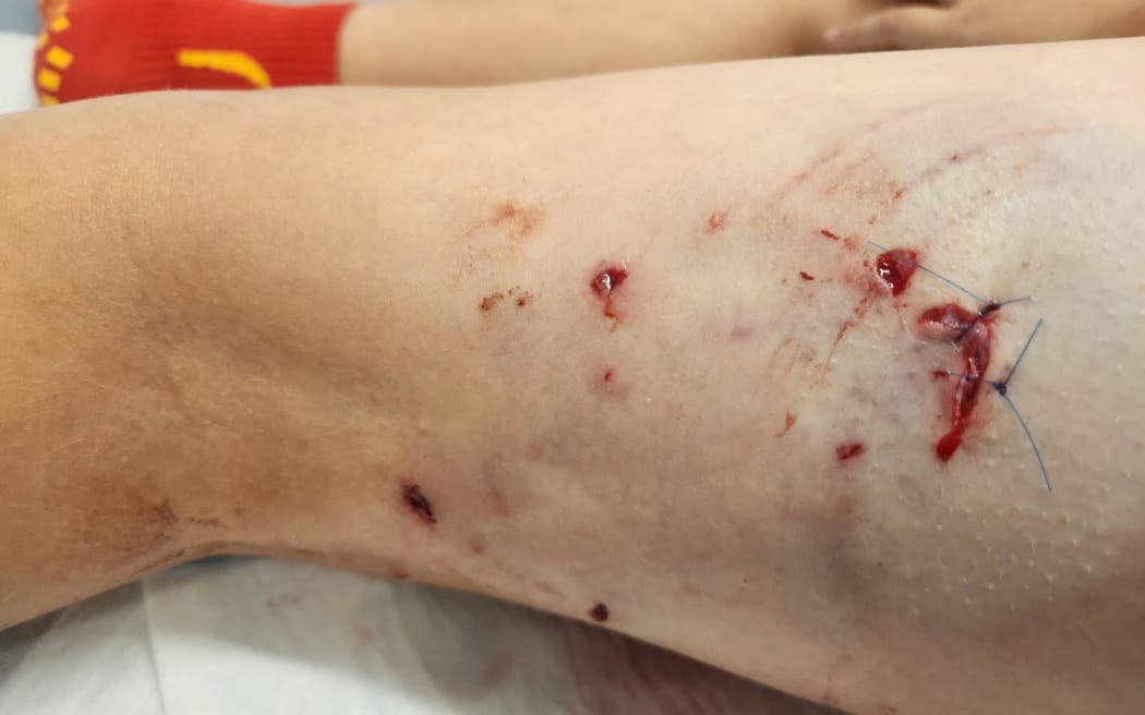 the stitches on Amie Clough’s son’s leg