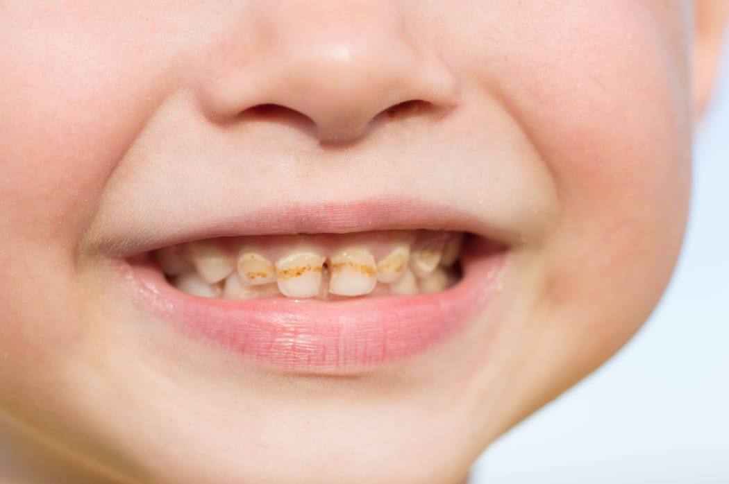 Close up child caries