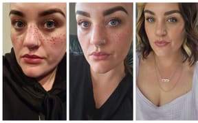 Alex Borrett and her freckle tattoos.