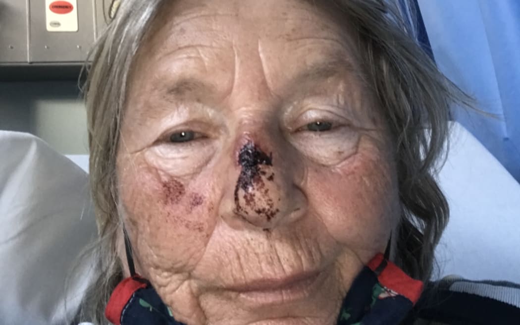 A bloodied Selah Weingott at Whanganui Hospital following the fishing charter on which she broke her nose and fractured her shoulder.