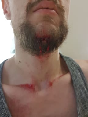 Liam Thompson, 27, was left him with a broken jaw, scrapes across his chest and wrists after an accident on a Lime e-scooter he was riding.