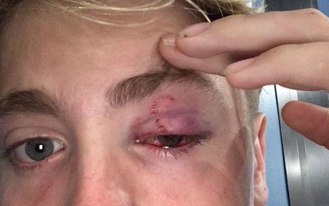 Jack Grunfeld lost 92 percent of sight in his left eye after an accident on a school trip.