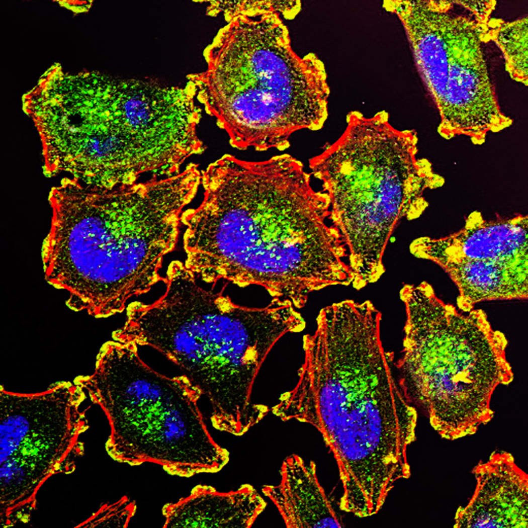 melanoma cells