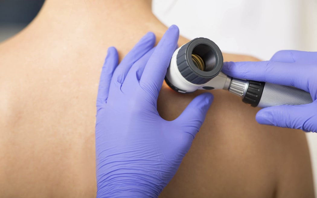 Mole dermoscopy.