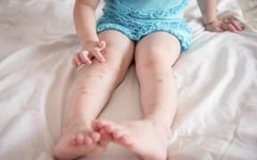 rash, bites, sea borne, sea lice rash