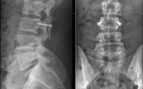 Orthopaedic spine surgeon Dr Rowan Schouten operates on a chronic back injury.