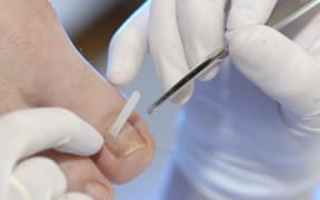 PEDICURE 
Photo essay from health professional's office. Photo essay in a podiatry surgery. Cares of podiatry. Orthonyxia placement of a strip on the nail to correct the curve. 

JOSE OTO / BSIP (Photo by JOSE OTO / BSIP / BSIP via AFP)