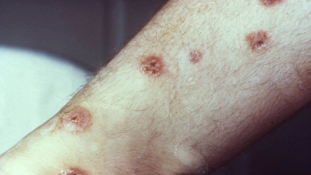 A patient with visible symptoms of syphilis. CDC/PUBLIC HEALTH IMAGE LIBRARY.