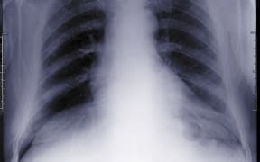 Chest, X-ray. (Photo by NICK VEASEY/SCIENCE PHOTO LIBRAR / NVY / Science Photo Library via AFP)
