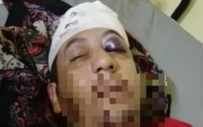 The assaulted Manus Island refugee.
