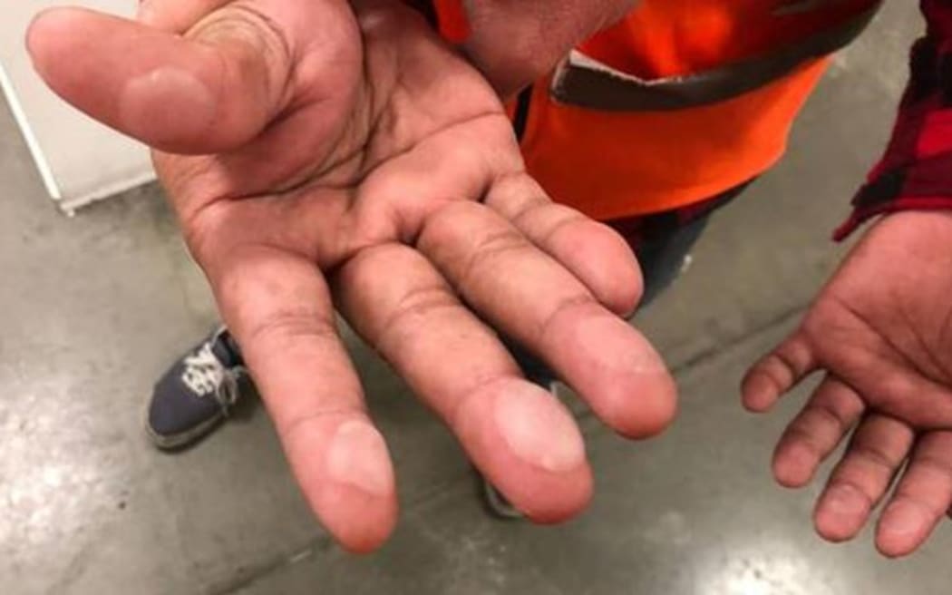 This image of a Sistema worker with blistered hands has been handed out at many distributing stores.