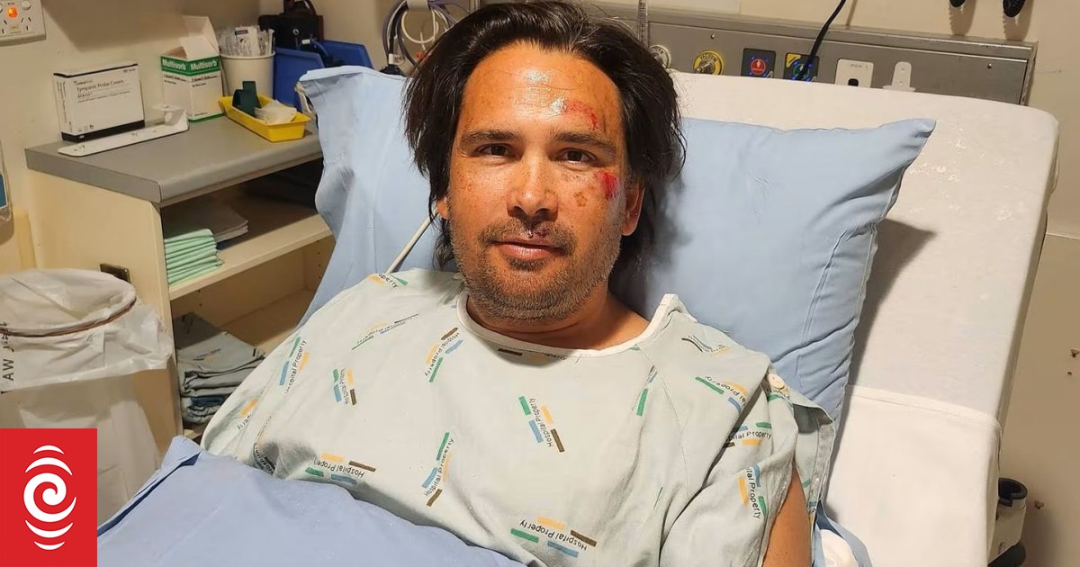 Auckland Business Chamber CEO Simon Bridges in hospital with broken wrist after e-scooter accident - Vimarsana News