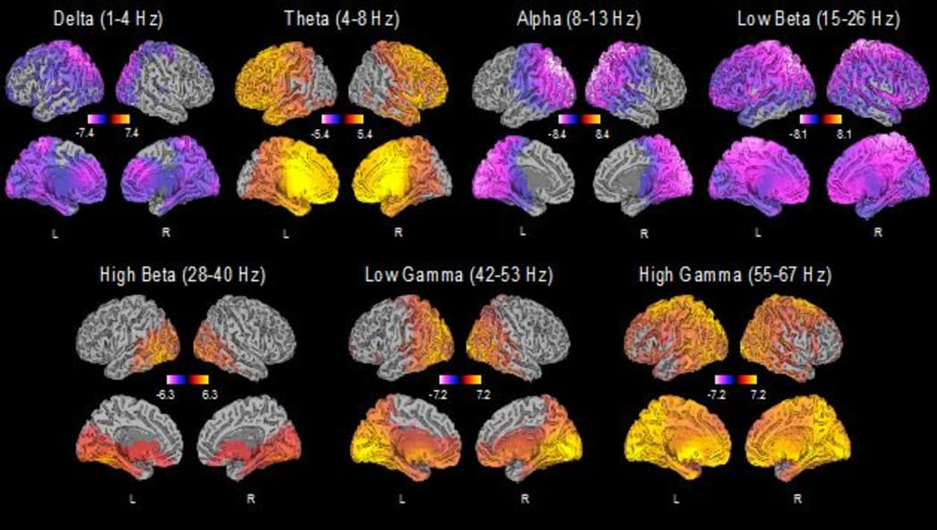 Brain activity changes in patients with treatment-resistant depression receiving ketamine as therapy