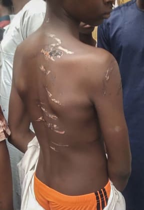 EDITORS NOTE: Graphic content / A boy shows his marks of torture pictured on September 26, 2019 in the Rigasa area of Kaduna in northern Nigeria where 300 male students of "different nationalities" were rescued by police from an Islamic seminary where they were tortured and sodomised.