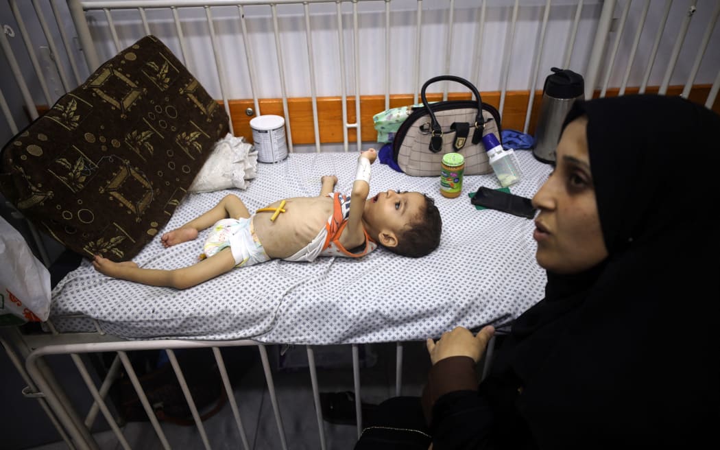 A Palestinian mother holds her child who suffers from malnutrition, at the Patient Friends Association Hospital in Gaza City, on 22 July, 2025.