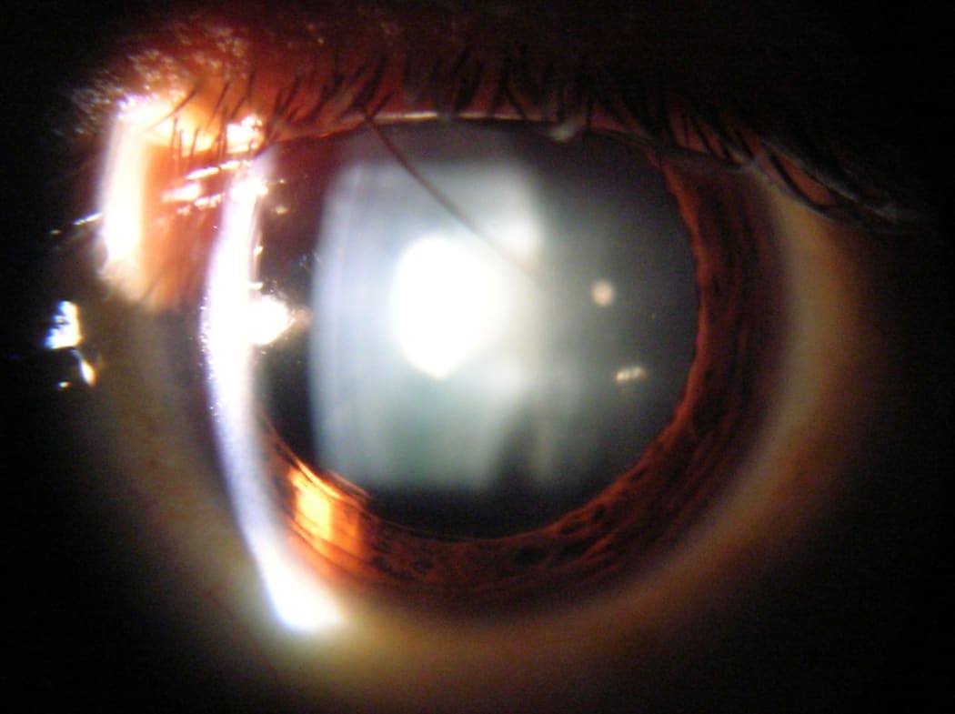 Slit lamp view of Cataract in Human Eye