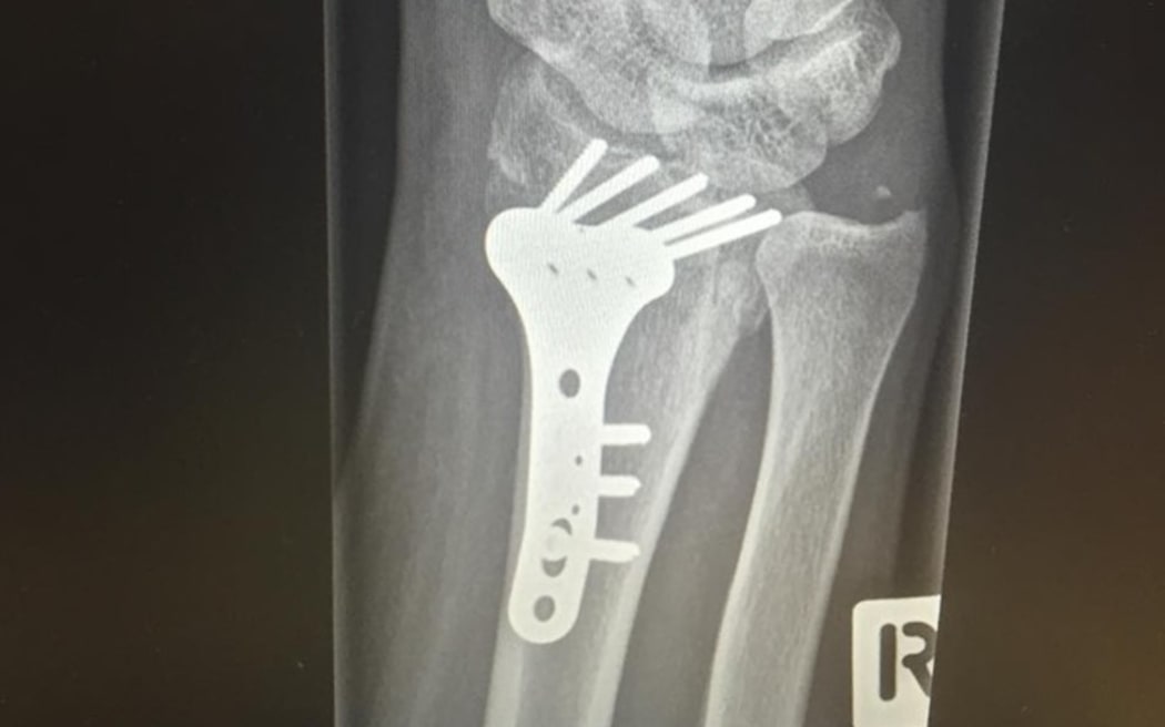 Black Ferns prop Aleisha-Pearl Nelson broke her wrist in 2016.