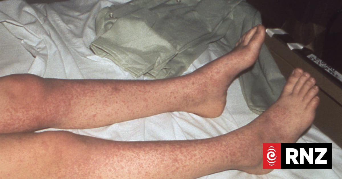New measles case in Wellington