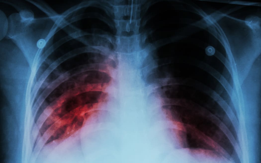 Pulmonary Tuberculosis ( TB )  :  Chest x-ray show alveolar infiltration at both lung due to mycobacterium tuberculosis infection